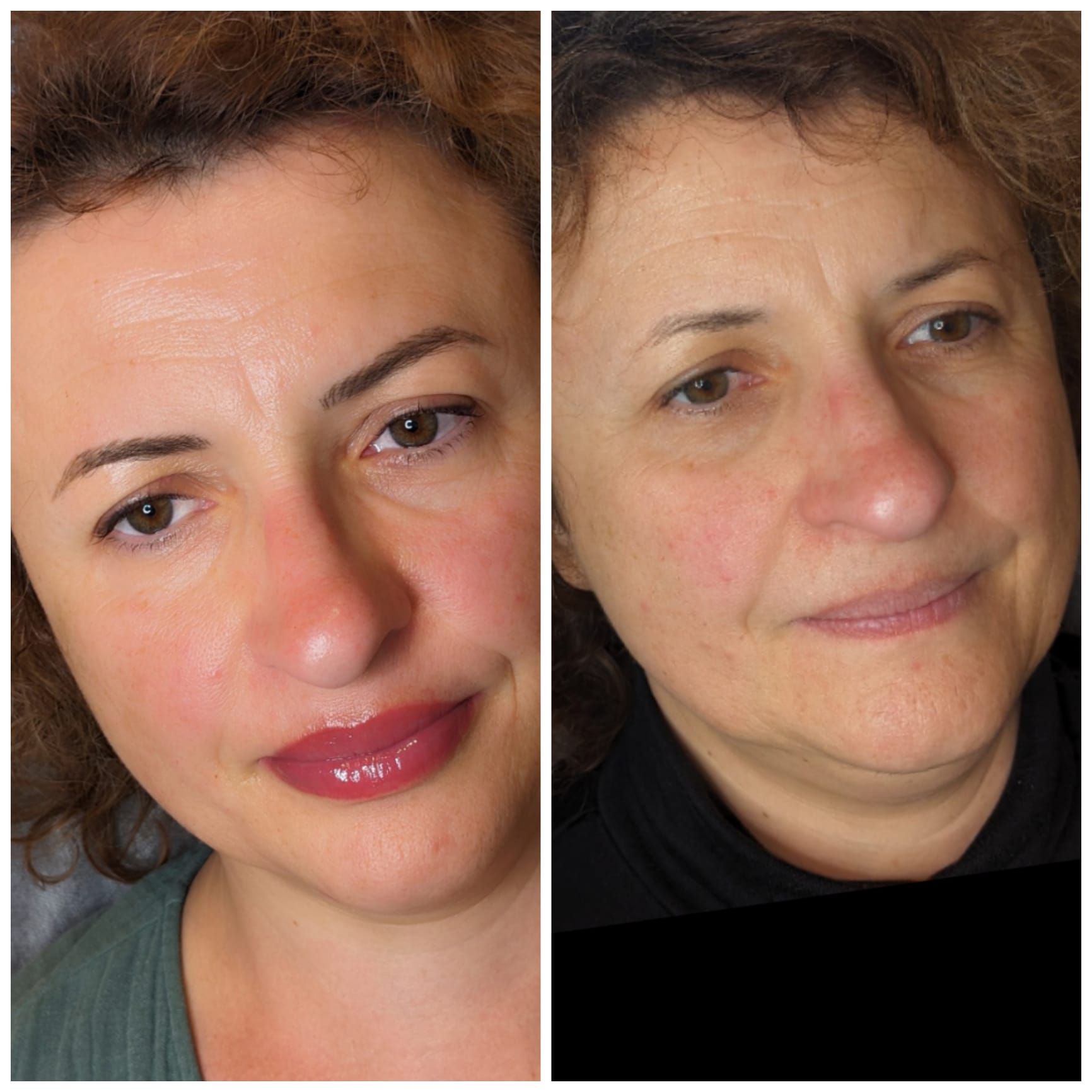 Vorher-Nachher einer Lippenpigmentierung mit betonter Kontur.
